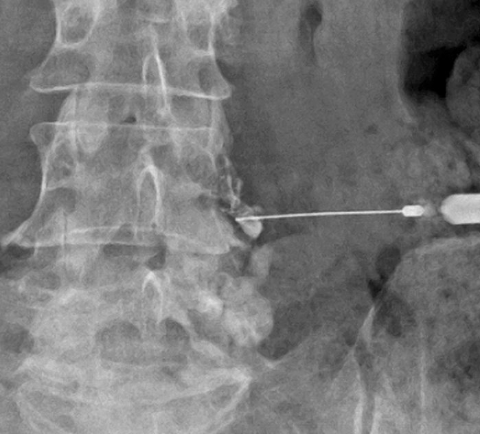 주사 치료 사진