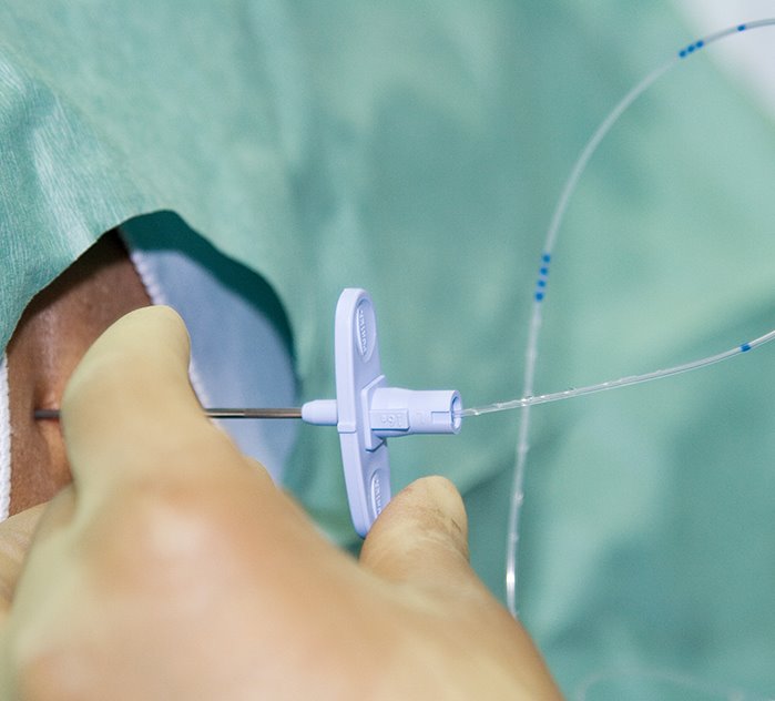 신경성형술 치료 사진