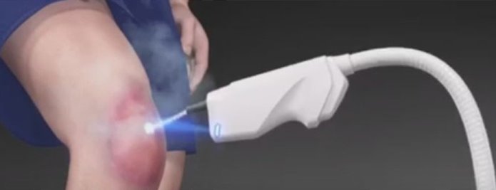 크라이오테라피 시술 사진