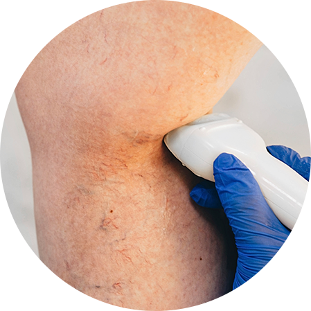 혈류 초음파 검사 사진